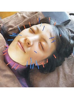 やまざき鍼灸整骨院/☆美容鍼灸にも特化