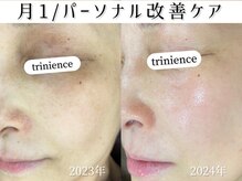 トリニエンス 新宿店(TRINIENCE)/40代/シミケア/沈着ケア