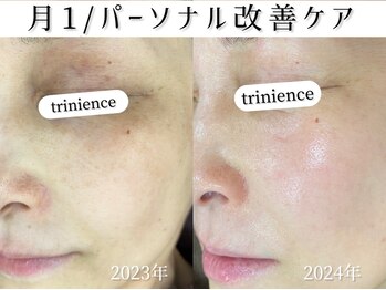 トリニエンス 新宿店(TRINIENCE)/40代/シミケア/沈着ケア