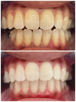 ルフレ(Reflet)/本格的な白さへ☆S14→S8