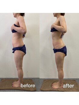 キアラ(chiara)/40代一回施術後