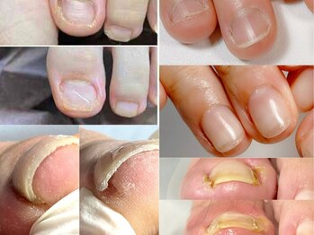 あしぁか 銀座の写真/【爪の救急箱】巻き爪・肥厚爪から手の深爪まで！専門技術で長年の爪の悩みを解消し、自信の持てる手足へ。