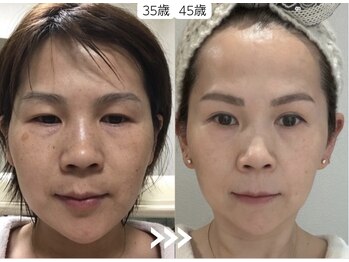 ココロ(COCORO)の写真/TV紹介・韓国発のピーリング◎剥離ダウンタイムなし・肌全般のお悩みならラミピールで改善・一度で実感♪