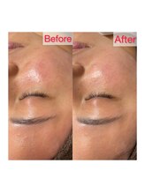 サロンドエデン 恵比寿店(Salon de Eden)/肌質改善