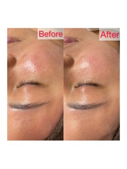 サロンドエデン 恵比寿店(Salon de Eden)/肌質改善