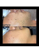 メンズ脱毛 リボーン(reborn)/ここまで変わる！