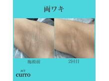 アクト クロ(ACT curro)/【両ワキ】脱毛施術例