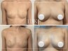 体験【バスト人気No.1☆】贅沢！新脂肪増加剤10ml業界初！高濃度特許成分配合
