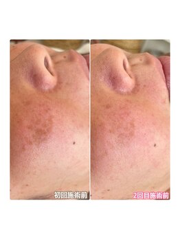 ジン フォー ユアビューティー(JIN for your beauty)/施術経過