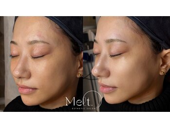 メルト 中目黒(Melt.)/*エレクトロポレーション