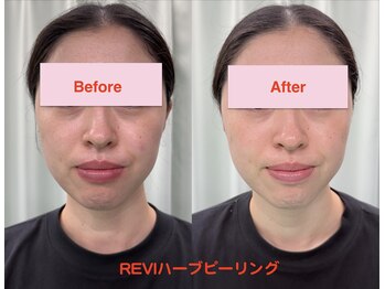 PNFインディバサロン/INDIBA×REVIハーブピーリング