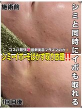 リズベット(LIZ BET)/期間限定!!シミナシキャンペーン