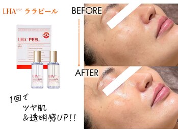 キレイベース 銀座店(KIREI BASE)/ララピール 1回での変化