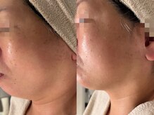 プラウディア(PROUDIA)/チタニウムリフト/たるみ/小顔