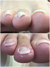 モアクリスタル(More Crystal)/巻き爪補正