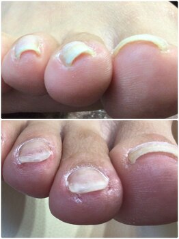 巻き爪補正