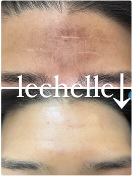 レシェルサロン(Lechelle Salon)/ハードハーブピーリング