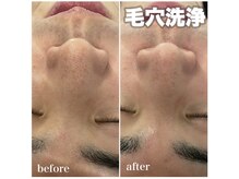 ネオファースト 大阪福島店(NeoFirst)/毛穴洗浄エレクトロ#毛穴#福島