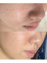 アトワ(A toi)/ハーブピーリング　ハードタイプ