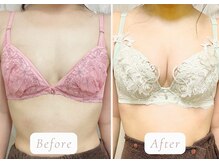 ノルン(Norn)/30代育乳バストケア（15回目）