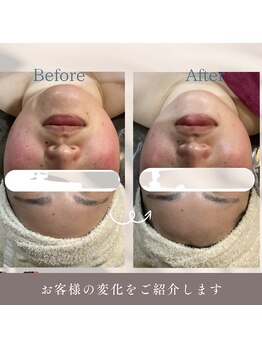 肌イズム つくば店(肌ism)/ララピール１回のお客様★