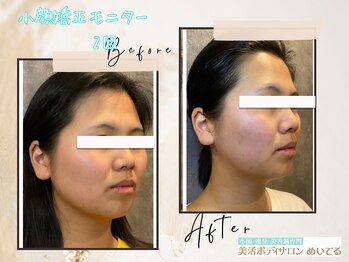 めいてる/【小顔矯正】2回の変化!