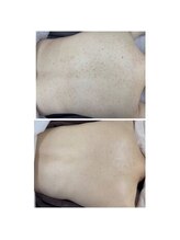 ニキビケア研究所 吉祥寺店/背中のニキビもここまで綺麗に☆