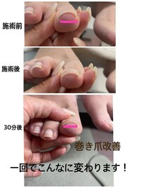 巻き爪改善♪