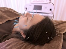 茶ノ木鍼灸整骨院の雰囲気（美容鍼 【Cosmetic Acupuncture】）
