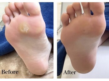 リゼラアンドコー 宇都宮店/タコ/角質ケア、Before＆After！