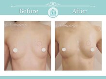 美人バスト 赤羽店/バストアップ・バストケア症例★