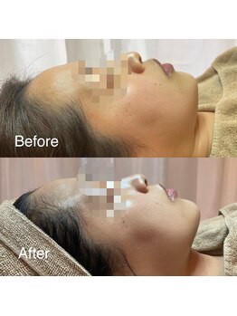 エー(A)/フェイスラインもスッキリ！