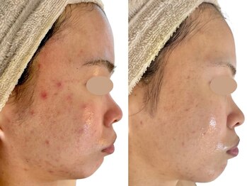 ニコレ(Nicore)/長年繰り返すニキビに終止符を