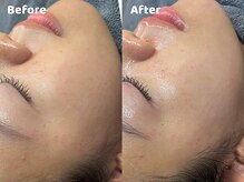 クリスタルビューティ 渋谷/NEW【韓国ミルクスキンピール】