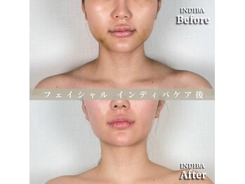 術後の女神 大阪本町店/ダウンタイムケア・インディバ