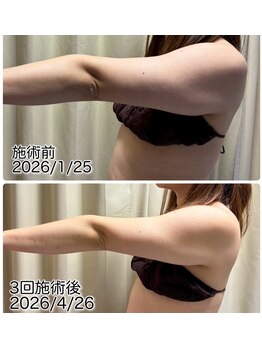 クールスパ(COOL SPA)/30代女性二の腕症例