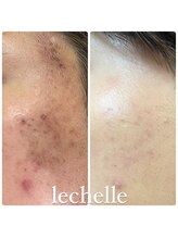 レシェルサロン(Lechelle Salon)/ハードハーブピーリング