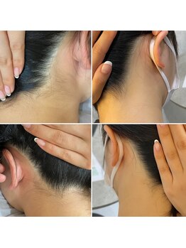 インベスト(INVEST)/うなじ脱毛