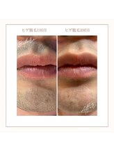 メンズラボ 京都山科店/【ヒゲ脱毛途中経過】