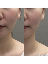 施術後のお顔の変化の最終チェックを行います。うわ～っ、凄い！とお喜び頂くことが多くあります♪