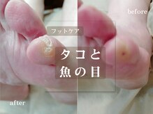菊桃(kikumomo)の雰囲気（つらいタコと魚の目！ポロっととれると、痛みが落ち着きます！）