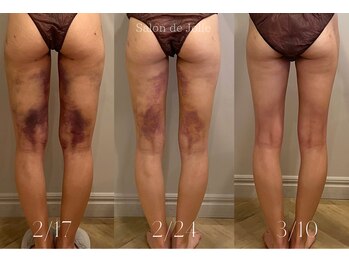 サロンドジョリー(Salon de Jolie)/【術後ダウンタイムケア】