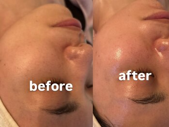 ベリーベリー(VERY-VERY)/ララピール/ビフォーアフター