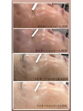 シャンディ(Shandy)/ラミピール☆5回目の経過と変化