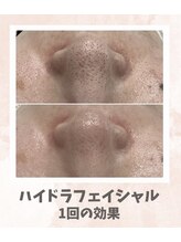 リンフェイス 浦安店(RINFACE)/頑固な黒ずみ毛穴にアプローチ