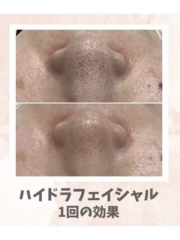 リンフェイス 浦安店(RINFACE)/頑固な黒ずみ毛穴にアプローチ