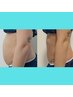 【話題の脂肪冷却チャレンジ】脂肪冷却×脂肪分解剤導入4カップ19,800円