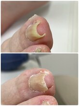 巻き爪じゅん 千葉駅前店/当院の施術で違和感のない生活を