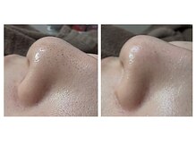 恵比寿脱毛 シーズ(She’s)の雰囲気(毛穴洗浄↑1回の効果↑お顔トライアル・5800円・OP小鼻・3800円)