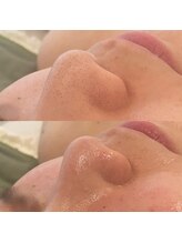 シルク(Silk)/3D毛穴SPA×お顔脱毛